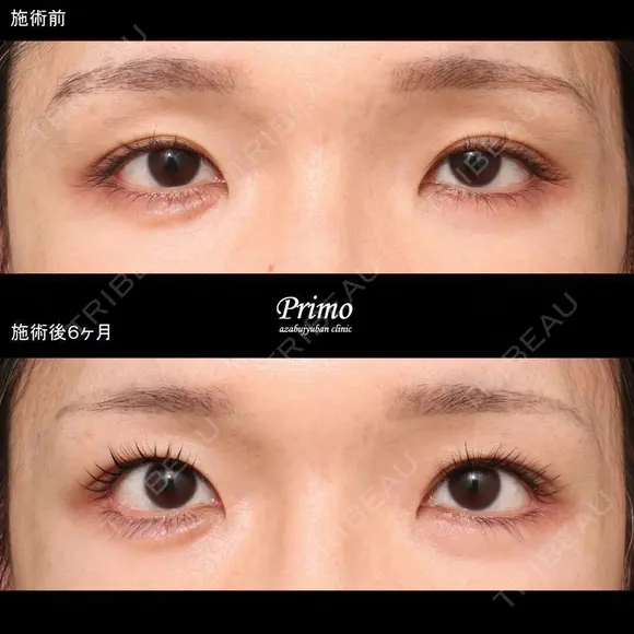 HP 眼瞼下垂手術＋下眼瞼拡大術＋目尻切開 180日後 メイン用