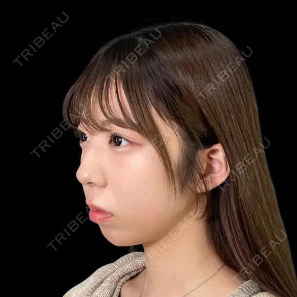 【あごヒアルロン酸】〜美人見えのヒミツは、あごにあり💎🤍〜 before画像 メイン用