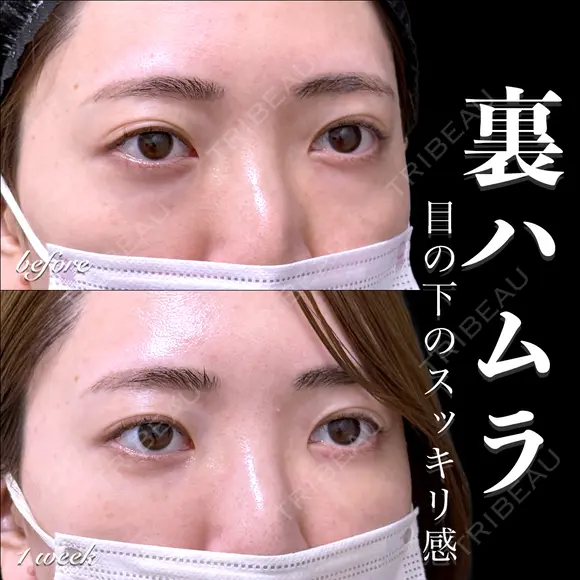 裏ハムラ before画像 メイン用