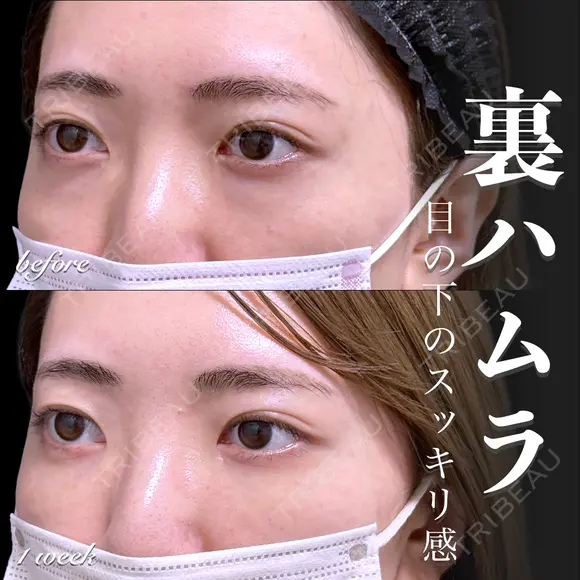 裏ハムラ 7日後 メイン用