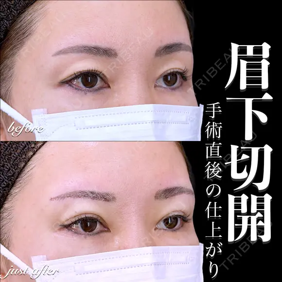 眉下切開 0日後 メイン用