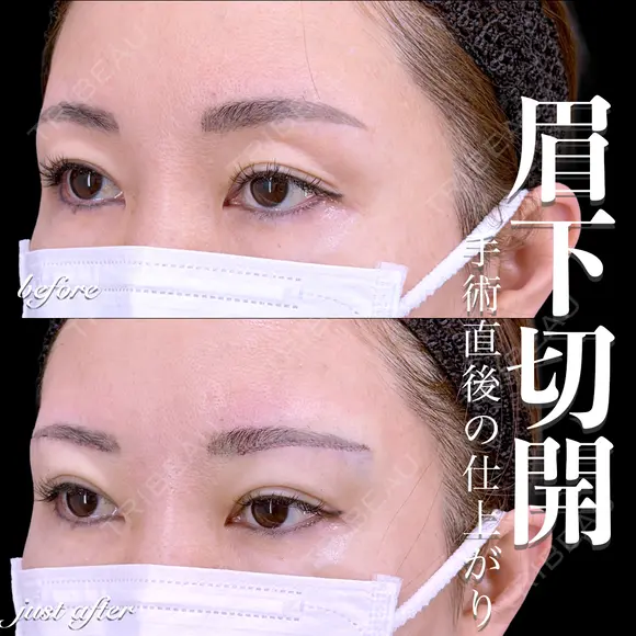 眉下切開 0日後 メイン用
