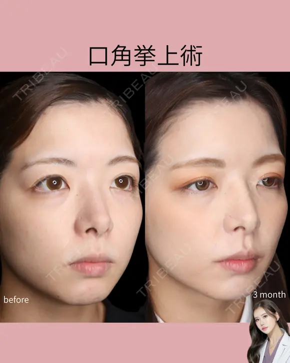 口角挙上 after画像 メイン用