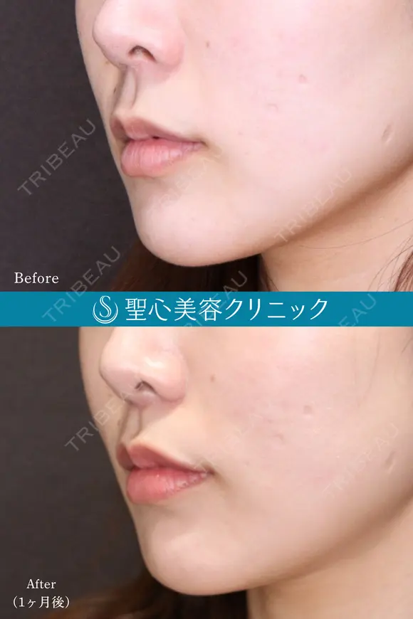 【20代女性鼻・唇・口角で上品な変化へ】①小鼻縮小+②人中短縮+③プレミアム口角挙上(10ヶ月後) after画像 メイン用