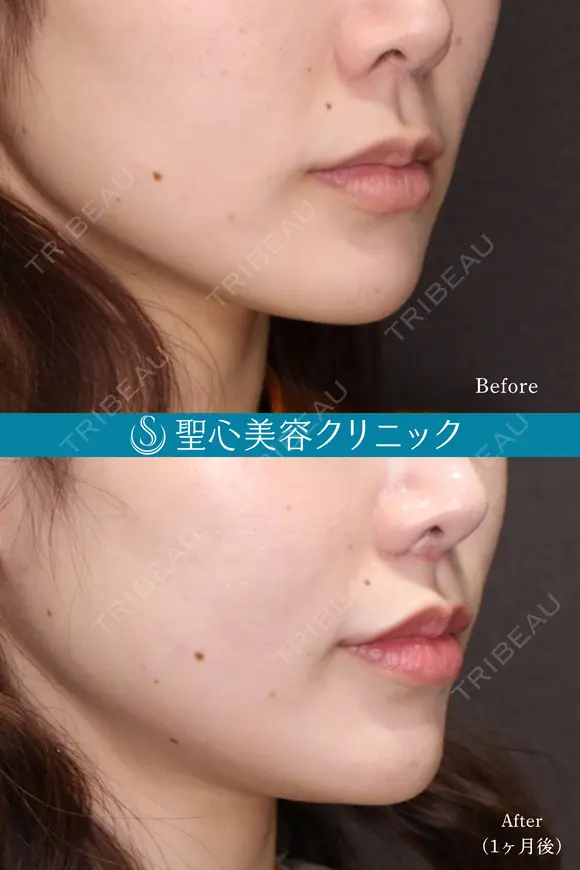 【20代女性鼻・唇・口角で上品な変化へ】①小鼻縮小+②人中短縮+③プレミアム口角挙上(10ヶ月後) after画像 メイン用