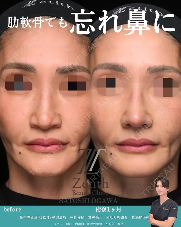 肋軟骨を使用した鼻中隔延長の症例です。 before画像 メイン用