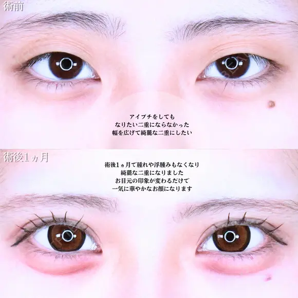 アリエルクイックループトリプル二重埋没法 before画像 メイン用