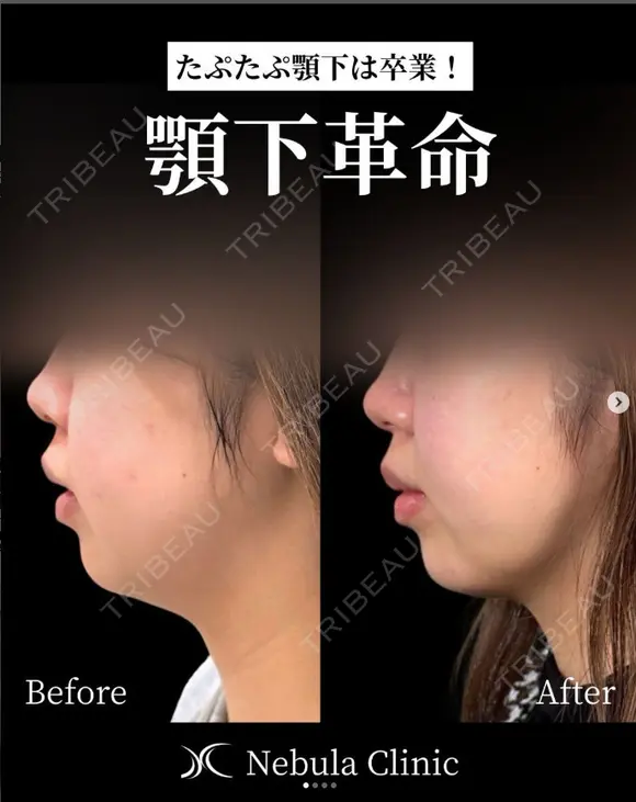 ⭐Dr都築⭐小顔カスタマイズ before画像 メイン用