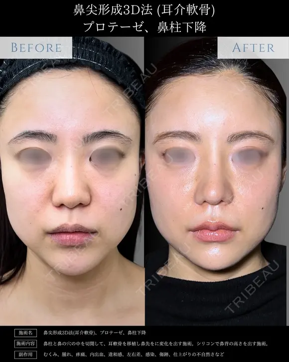 【鼻フル整形】鼻尖形成3D法＋耳介軟骨移植＋鼻柱下降＋プロテーゼ after画像 メイン用