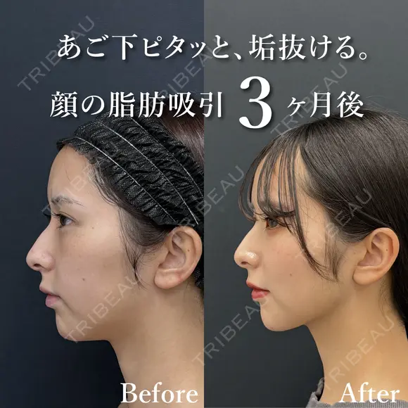 ベイザー併用アキーセル脂肪吸引(ホホ・ジョールファット・あご下) after画像 メイン用