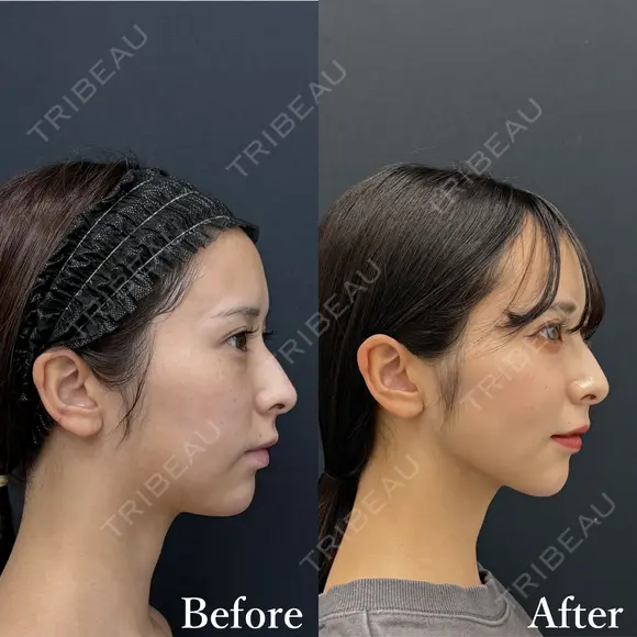 ベイザー併用アキーセル脂肪吸引(ホホ・ジョールファット・あご下) after画像 メイン用