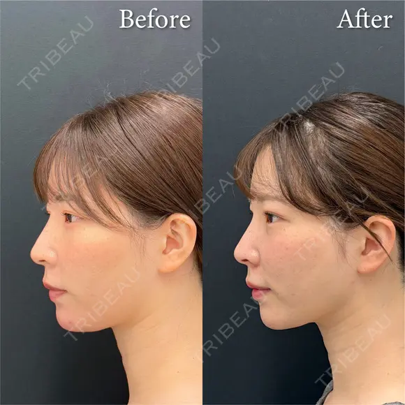 脂肪吸引注射 after画像 メイン用