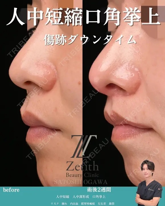 人中短縮と口角挙上の術後2週間の方です。 14日後 メイン用