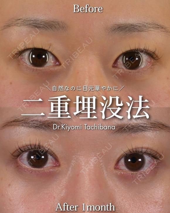 Zetith Eyes(3点留め埋没)  30日後 メイン用