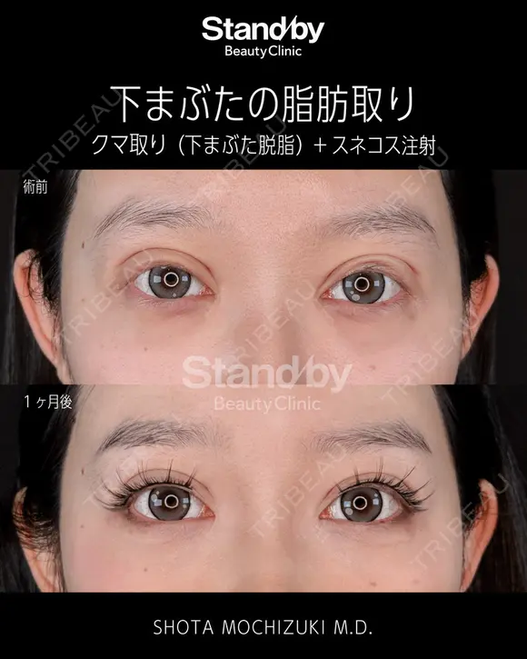 下まぶたの脂肪取り before画像 メイン用