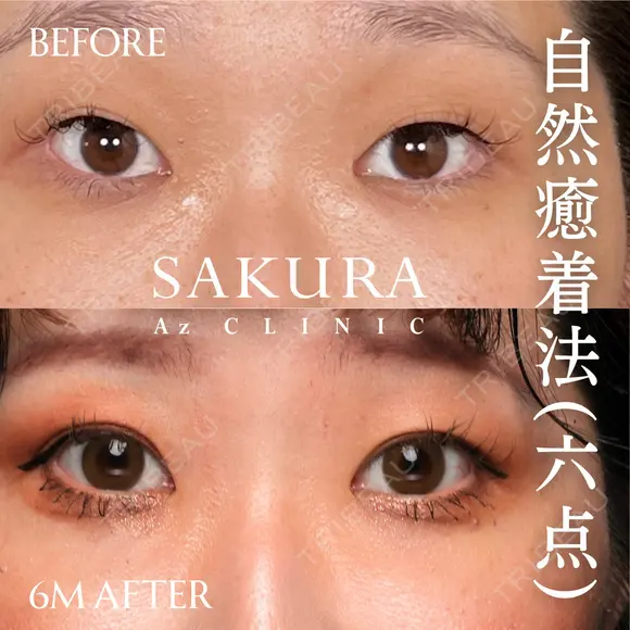 二重埋没(自然癒着6点留め) before画像 メイン用