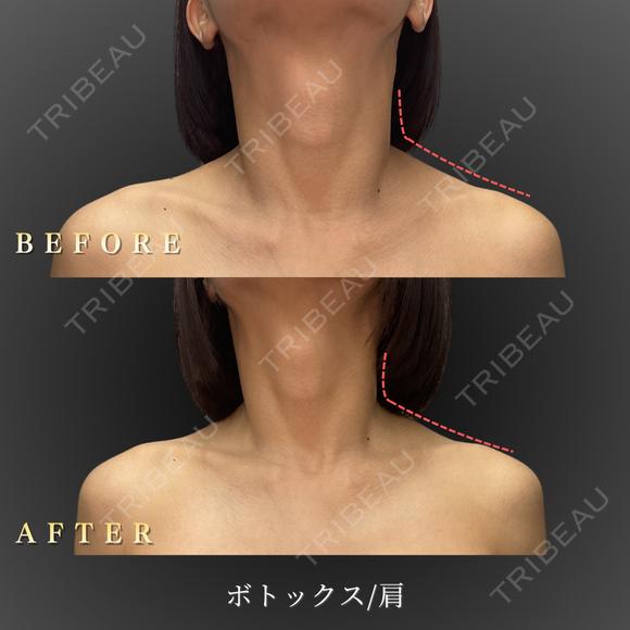 肩ボトックス before画像 メイン用