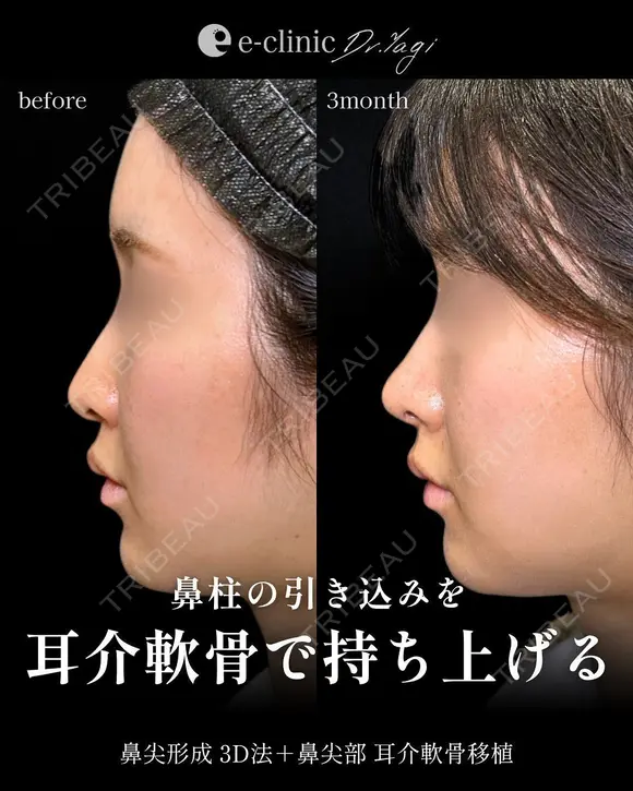 鼻整形（鼻柱を耳介軟骨で持ち上げる） after画像 メイン用