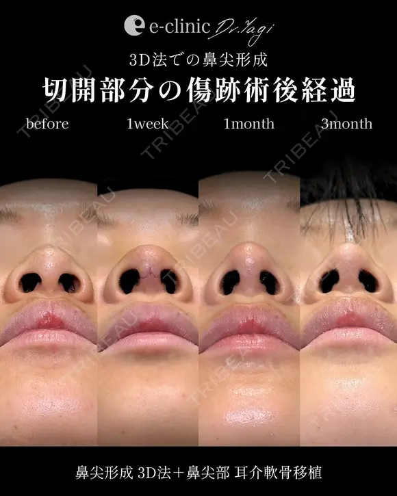 鼻整形（鼻柱を耳介軟骨で持ち上げる） before画像 メイン用