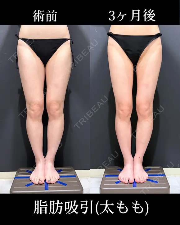 太もも脂肪吸引 before画像 メイン用