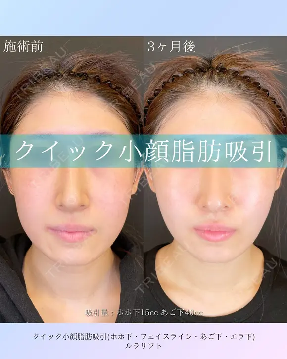 クイック小顔脂肪吸引・ルラリフト before画像 メイン用