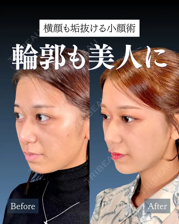 岩﨑先生による🔥小顔整形🔥 after画像 メイン用