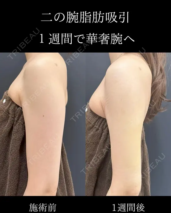 二の腕脂肪吸引 before画像 メイン用