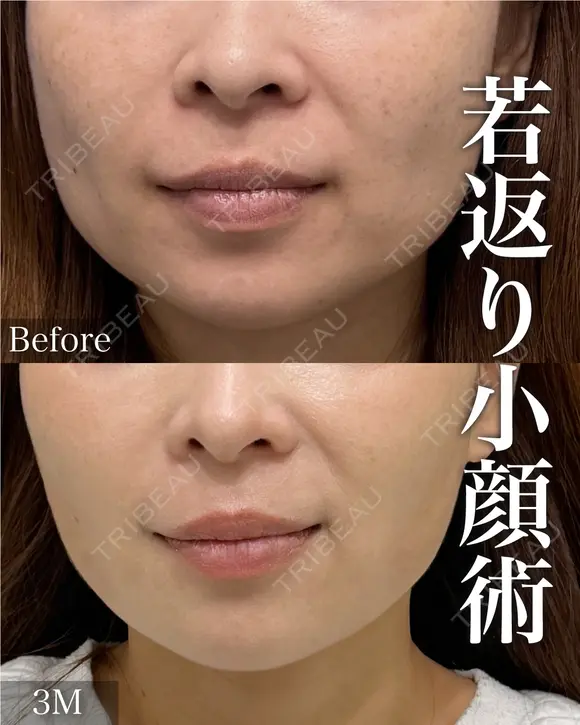 美ボディ脂肪吸引 after画像 メイン用