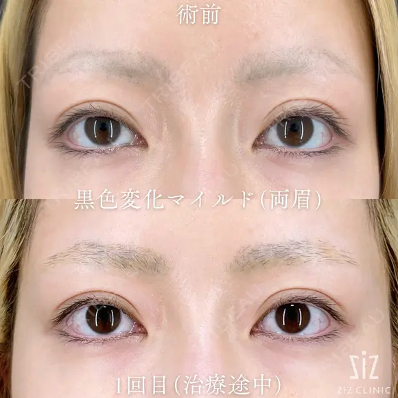 【アートメイク除去】他院薬剤除去2回... before画像 メイン用
