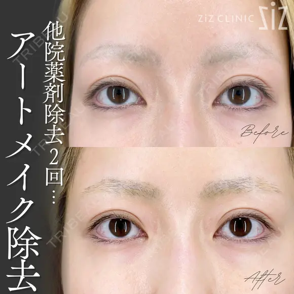 【アートメイク除去】他院薬剤除去2回... after画像 メイン用