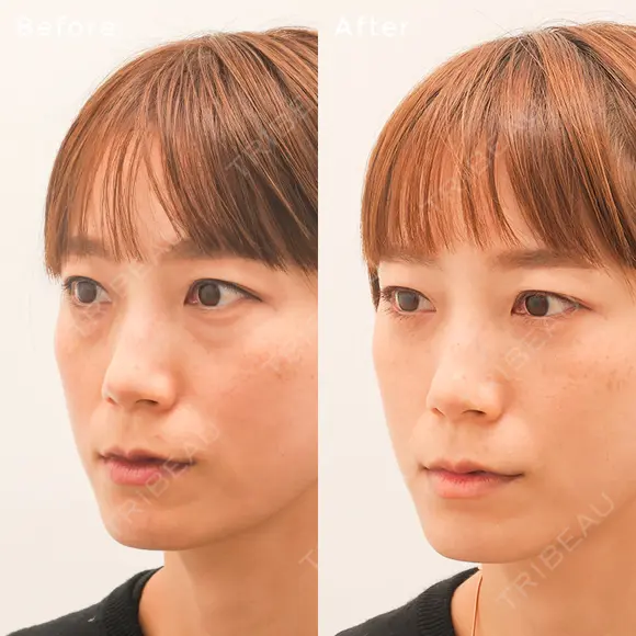 下眼瞼脱脂(経結膜)＋リガメント外し before画像 メイン用
