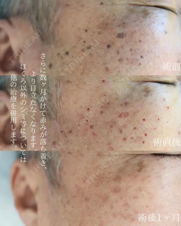 ほくろ取り　いぼ取り before画像 メイン用