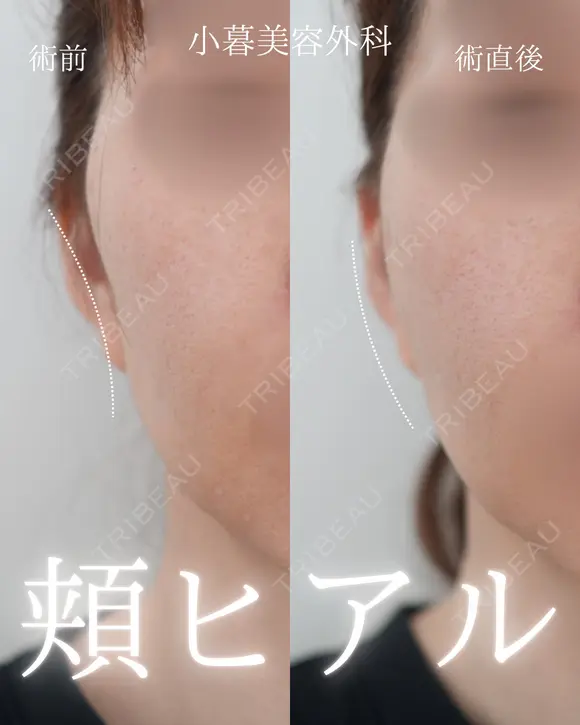 頬ヒアルロン酸 0日後 メイン用