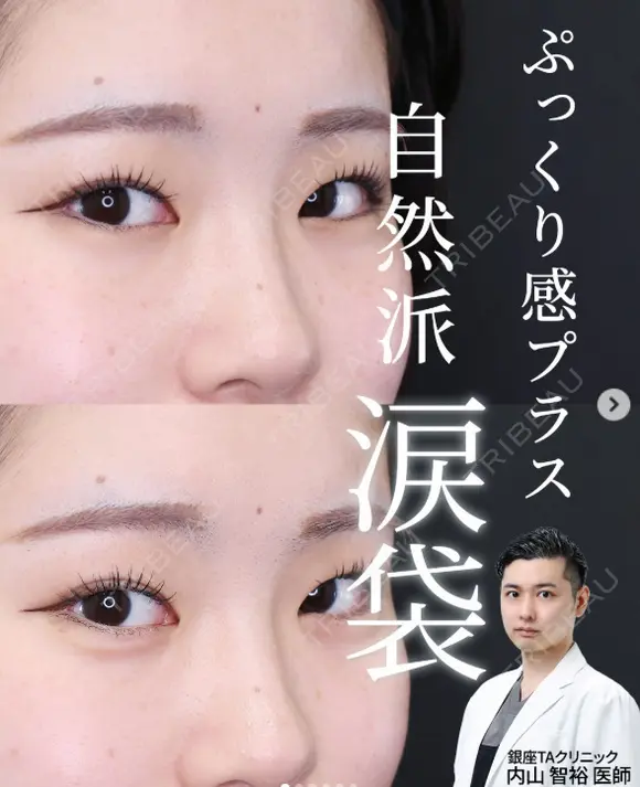 涙袋ヒアル after画像 メイン用