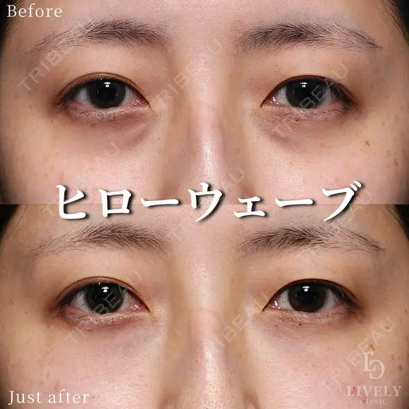 ヒローウェーブ（目の下） before画像 メイン用