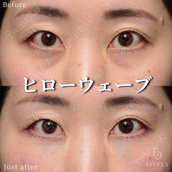 ヒローウェーブ（目の下） after画像 メイン用