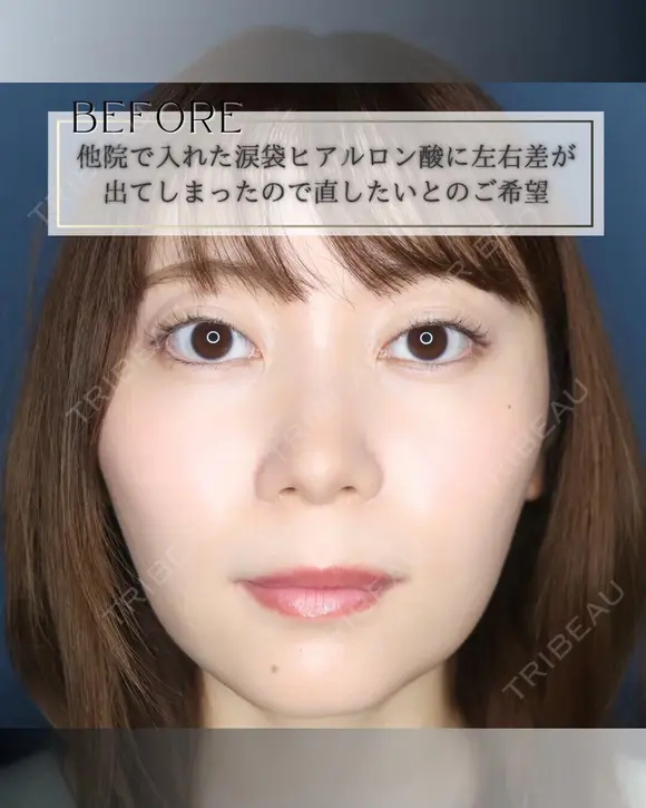 涙袋ヒアルロン酸 before画像 メイン用
