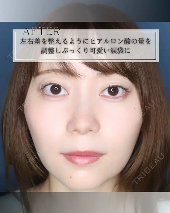 涙袋ヒアルロン酸 after画像 メイン用
