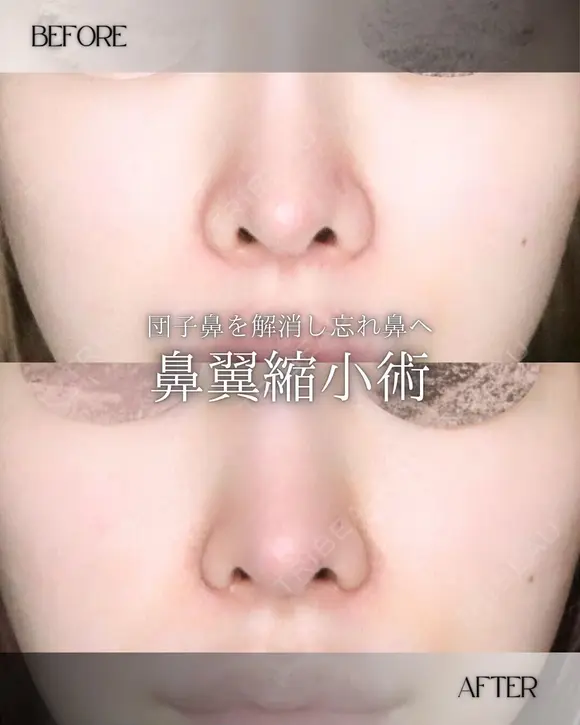 小鼻縮小 before画像 メイン用