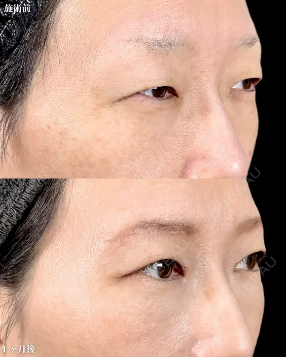 【眉下切開】でパッチリ目に👀 before画像 メイン用