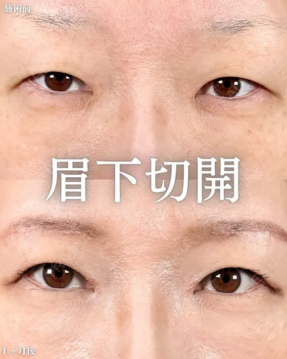 【眉下切開】でパッチリ目に👀 after画像 メイン用