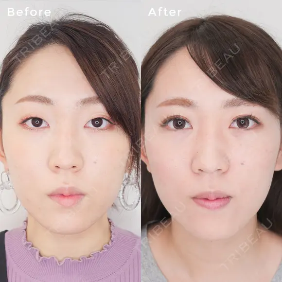 埋没法ダブル before画像 メイン用
