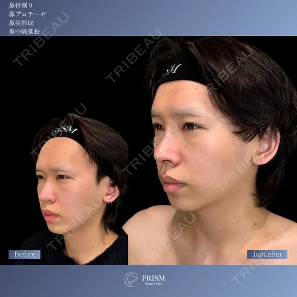 ✨オーダーメイドで叶える理想の鼻✨ 0日後 メイン用
