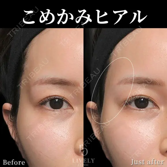 こめかみヒアルロン酸 after画像 メイン用