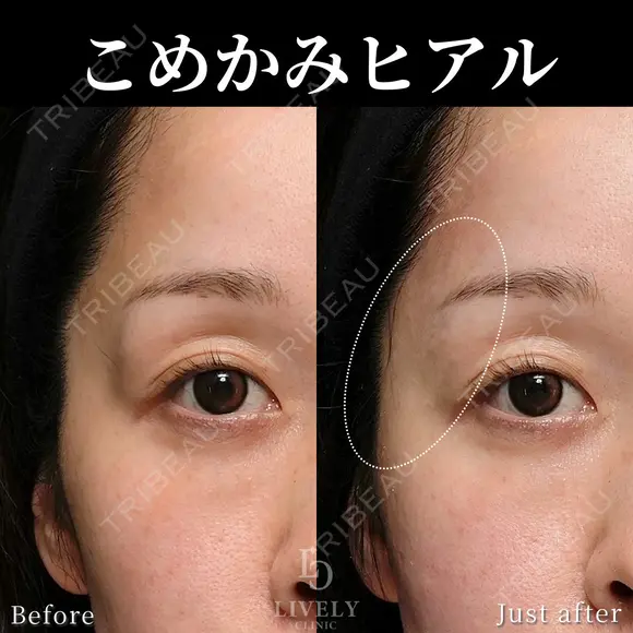 こめかみヒアルロン酸 before画像 メイン用