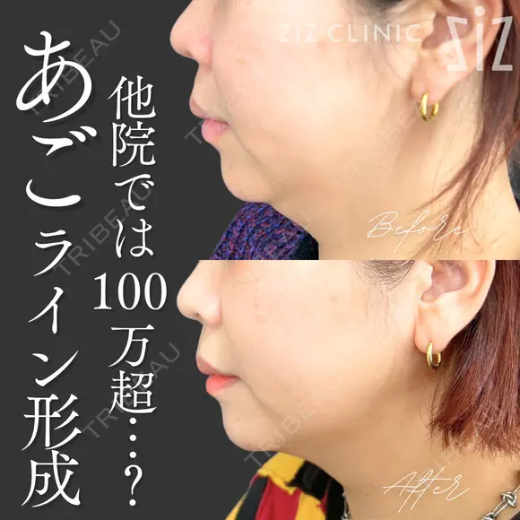 【ミニ脂肪吸引】他院では100万超…？ after画像 メイン用