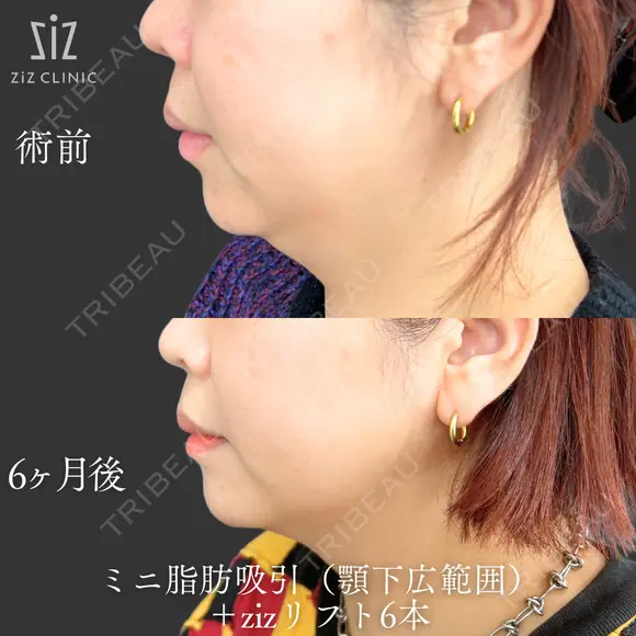【ミニ脂肪吸引】他院では100万超…？ before画像 メイン用