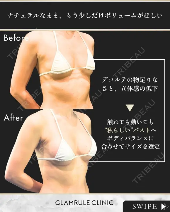 シリコンバッグ豊胸 30日後 メイン用