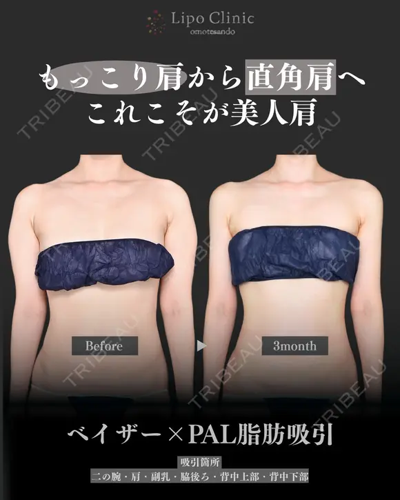 二の腕+肩、副乳脂肪吸引 90日後 メイン用