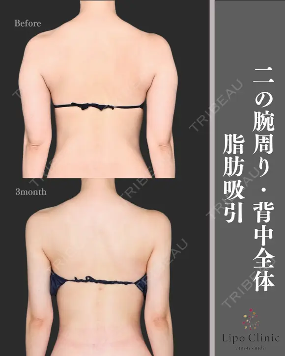 二の腕+肩、副乳脂肪吸引 before画像 メイン用